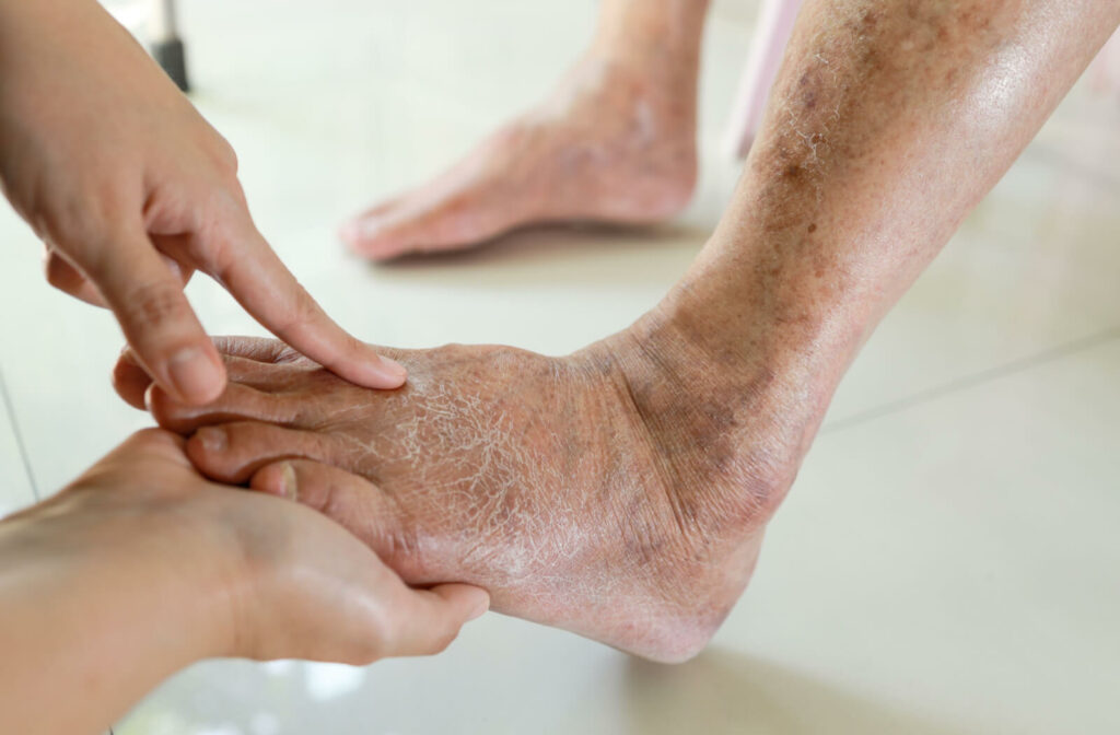 A close-up foot of an elderly showing cracked dry skin as a sign of malnutrition.